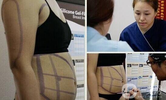 全身吸脂減肥價格