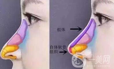 北京整容墊鼻梁多少錢？附隆鼻價(jià)格明細(xì)一覽表