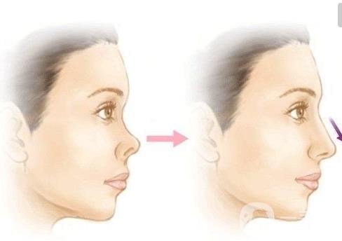 北京朝天鼻整容多少錢?具體怎么改良？