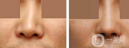 歪鼻矯正手術(shù)