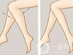 *瘦小腿一般多少錢？