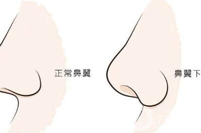 鼻翼缺損矯正*大嗎？要多少錢？