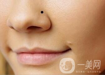 鼻翼缺損矯正*大嗎？要多少錢？