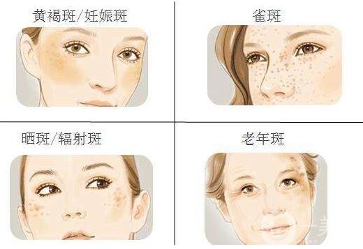 激光祛斑*果怎么樣?會復(fù)發(fā)嗎?