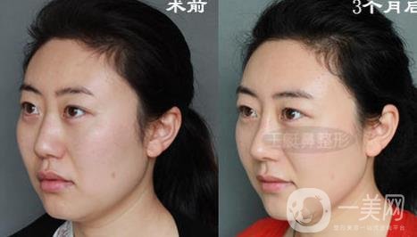 韓式肋軟骨隆鼻