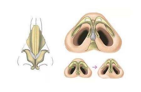 鼻頭肥大縮小術(shù)是持久*的嗎？