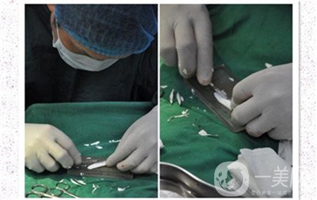 膨體材料隆鼻有哪些優(yōu)勢呢?