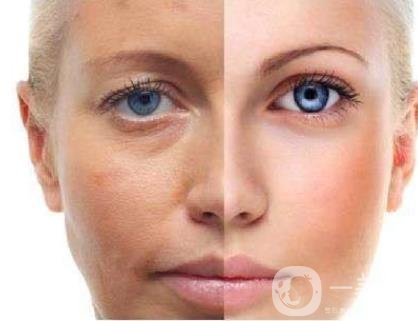 激光祛斑好嗎？需要打麻藥嗎？