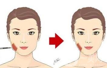 咬肌切除手術(shù)多少錢?有哪些影響因素?