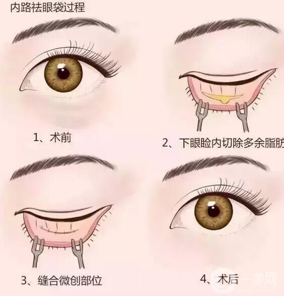 外切去眼袋后恢復期應該注意什么?