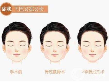 下頜角手術(shù)術(shù)后護(hù)理要注意哪些？