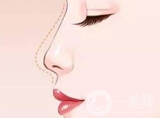 硅膠隆鼻假體取出術(shù)后護(hù)理注意事項(xiàng)有哪些呢?