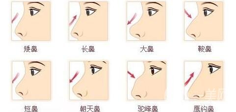 人工骨粉隆鼻*嗎?對人體有害嗎?