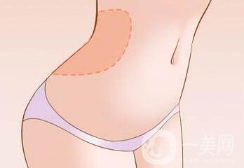 腹壁整形多少錢？費(fèi)用詳細(xì)解說