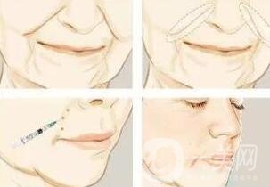 去鼻唇溝多少錢?哪種材料便宜些?