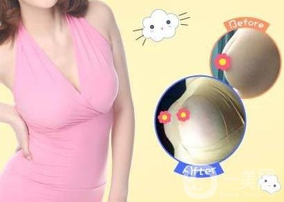 娜高豐胸假體好不好？需要多少錢？