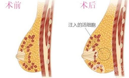 自體細胞豐胸*果自然嗎？要恢復多久？