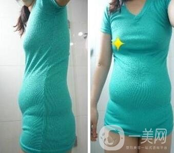 全身抽脂價(jià)格