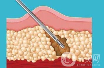 360度環(huán)形吸脂疼不疼？是全麻嗎？
