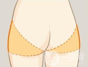 360度環(huán)形吸脂疼不疼？是全麻嗎？