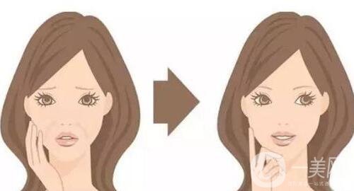 玻尿酸豐臉頰價格多少錢?怎樣計算?