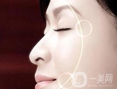 大拉皮除皺恢復時間要多久?可以做第二次嗎?