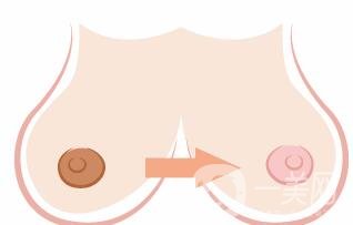 乳暈黑怎么辦?可以漂紅嗎?