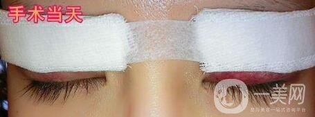 雙眼皮手術