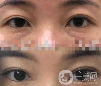 雙眼皮手術