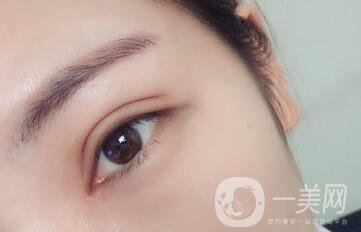 做雙眼皮手術(shù)