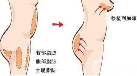 自身脂肪移植隆胸術(shù)有沒有副作用？