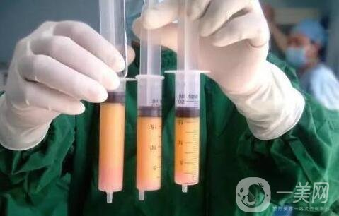 全身抽脂手術(shù)要多長時間，會全麻嗎?