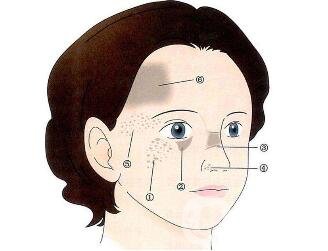 祛斑手術(shù)價格貴不貴？要多少錢？