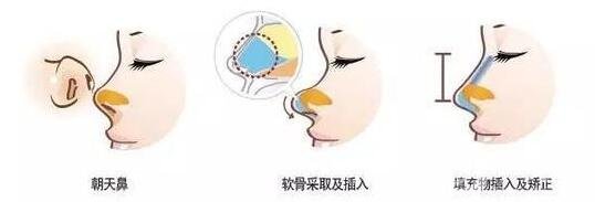 朝天鼻整形價(jià)格貴嗎?大概要多少錢?
