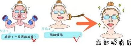 抽脂瘦臉手術(shù)過程*嗎?術(shù)后*果*嗎?