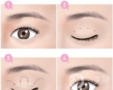 *需要拆線嗎？多長(zhǎng)時(shí)間可以碰水？