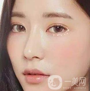 *需要拆線嗎？多長(zhǎng)時(shí)間可以碰水？