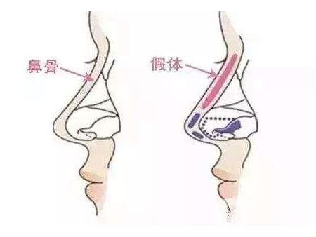 假體隆鼻整型術(shù)術(shù)前準(zhǔn)備有哪些？