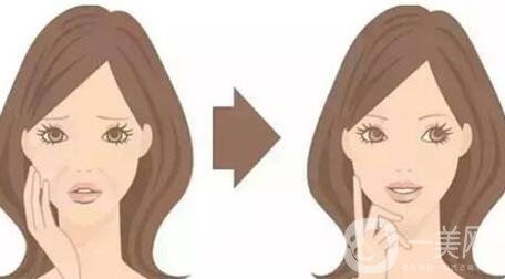 頸部除皺提升術(shù)