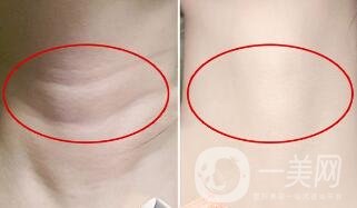 頸部除皺提升術(shù)