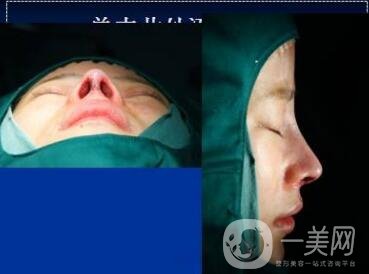 隆鼻手術(shù)