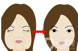 冰電波拉皮除皺*果如何？有哪些優(yōu)點(diǎn)？