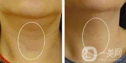 冰電波拉皮除皺*果如何？有哪些優(yōu)點(diǎn)？