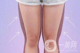 大腿環(huán)形吸脂多久恢復(fù)？會有疤嗎？