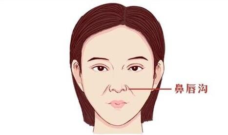 鼻唇溝填充術(shù)一般用什么材料?哪種材料比較好?