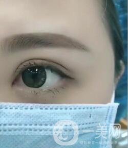 做雙眼皮手術(shù)過(guò)程