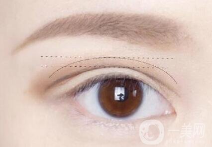 做雙眼皮手術(shù)過(guò)程