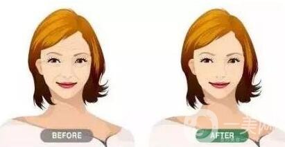 瑞蘭玻尿酸注射除皺價(jià)格要多少錢？