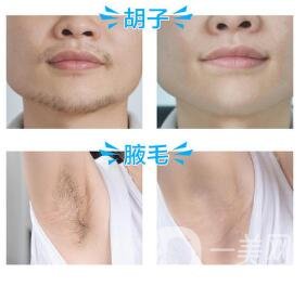 臉部脫毛