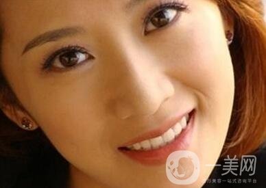 墊個鼻子要多少錢？大概價位是多少？